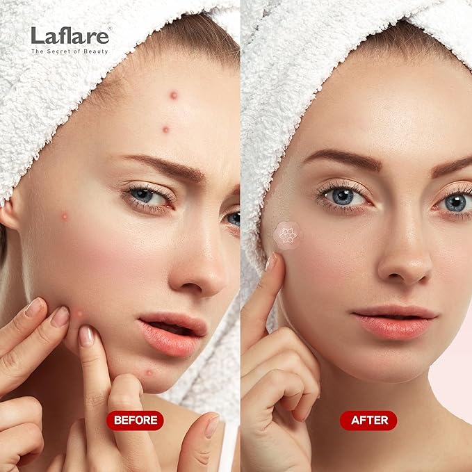 FreeGo Magnesium Acne Patches for Face. Blemish.Zit & Dark Spots from Post-Blemish, Acne .Zit. Self Dissolving,Hydrocolloid, Tee Tree oil & more (M 10pc)