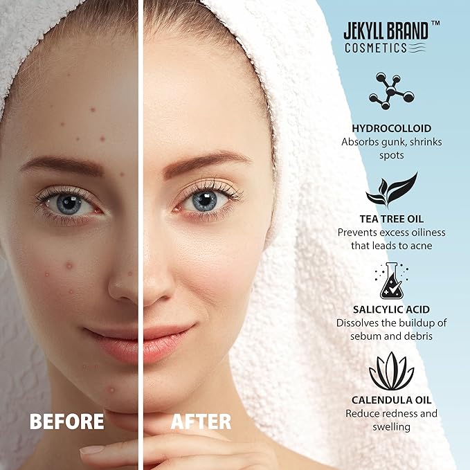 Pimple Patch for Cheeks (12 counts) COSMETICS™ | Medical Grade Hydrocolloid | Acne Patch for Covering Zits and Blemish | Cheeks Patches for Acne | **Dermatologist Approve**