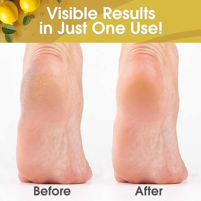 DeEnti Callus Remover for Feet, Extra Strength Foot Callus Remover Gel, 8oz Salon Grade Home Pedicure Supplies for Dry Skin, Cracked Heel, Professional Strength Foot Care, Lemon